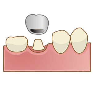 むし歯の治療方法について トヨムラ歯科医院